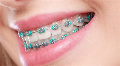 dental ortho metal dental orthodontic brackets|metal braces with clear bands.